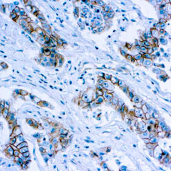 Formalin fixed paraffin embedded human lung carcinoma stained with Catenin β