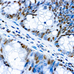 Formalin fixed paraffin embedded human colon adenocarcinoma stained with c-myc.