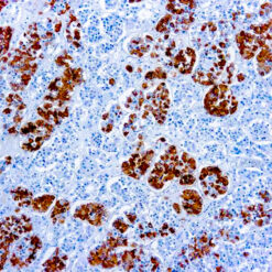 Formalin fixed paraffin embedded human pituirtary stained with Adrenocorticotropic Hormone