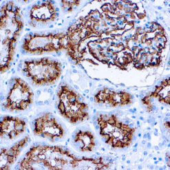 Formalin fixed paraffin embedded human renal cell carcinoma stained with CD10.