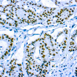 Formalin fixed paraffin embedded human colon carcinoma stained with CD56/NCAM-1 antibody.