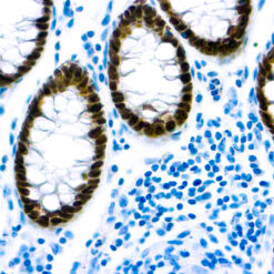 Formalin fixed paraffin embedded colon carcinoma stained with CDX2 antibody.