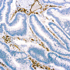 Formalin fixed paraffin embedded human Colon Ca stained with CD31 antibody.