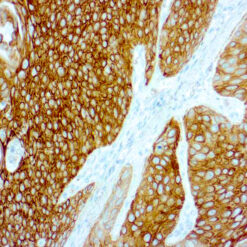 Formalin fixed paraffin embedded lung squamous cell Ca. stained with Cytokeratin 5/6.