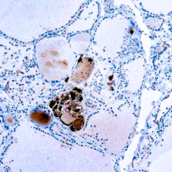 Formalin fixed paraffin embedded human thyroid stained with Calcitonin