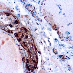 Formalin fixed paraffin embedded human thyroid medullary carcinoma stained with Calcitonin