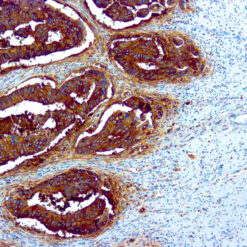 Formalin fixed paraffin embedded human colon Ca stained with CEA antibody