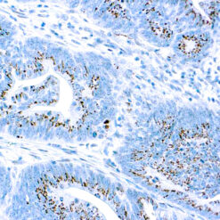 Formalin fixed paraffin embedded human Adeno Colon Ca stained with Caspase 3/CPP32
