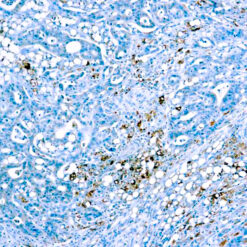 Formalin fixed paraffin embedded human prostate stained with Cathepsin DFormalin fixed paraffin embedded human prostate stained with Cathepsin D