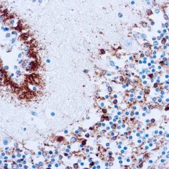Formalin fixed paraffin embedded Alzheimer brain stained with Tau.