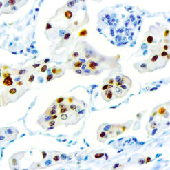 Formalin fixed paraffin embedded human Breast Carcinoma stained with Cyclin D1.