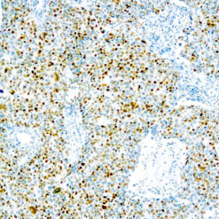 Formalin fixed paraffin embedded human breast Ca. stained with Cyclin E antibody.