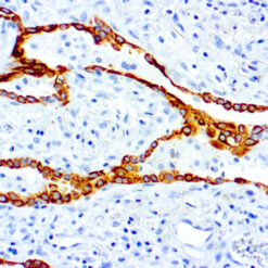 Formalin fixed paraffin embedded breast carcinoma stained with Cytokeratin 7