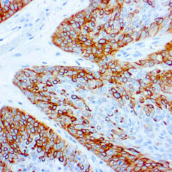 Formalin fixed paraffin embedded lung squamous cell carcinoma stained with Cytokeratin 14 antibody