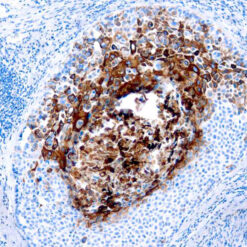 Formalin fixed paraffin embedded human lung squamous cell carcinoma stained with Cytokeratin 17 antibody.