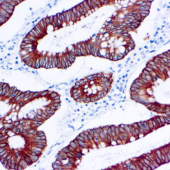 Formalin fixed paraffin embedded human human colon carcinoma stained with Cytokeratin 18 antibody.