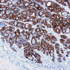 Formalin fixed paraffin embedded human human colon carcinoma stained with Cytokeratin 19 antibody