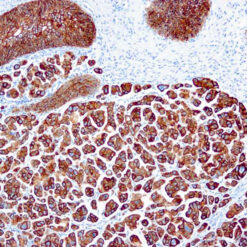 Formalin fixed paraffin embedded human lung adenocarcinoma stained with Cytokeratin 7 antibody.