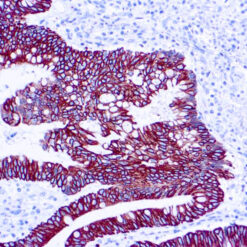 Formalin fixed paraffin embedded human colon adenocarcinoma stained with Cytokeratin 8/18 antibody.