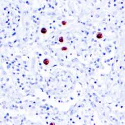 Formalin fixed paraffin embedded human infected tissue stained with CMV antibody.