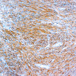 Formalin fixed paraffin embedded gastrointestinal stromal tumor staiend with D0G1 antibody.