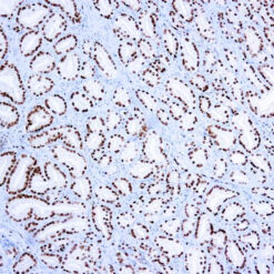 Formalin fixed paraffin embedded human prostate carcinoma stained with ERG antibody.