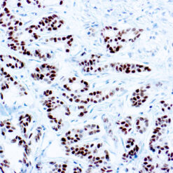 Formalin fixed paraffin embedded human breast carcinoma stained with Estrogen Receptor antibody