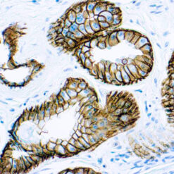 Formalin fixed paraffin embedded human breast carcinoma stained with Epithelial Antigen.
