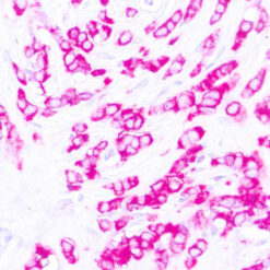 Formalin fixed paraffin embedded human breast carcinoma stained with Epithelial Antigen.