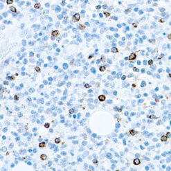 Formalin fixed paraffin embedded human infected tissue stained with EBV.
