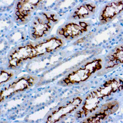 Formalin fixed paraffin embedded renal cell carcinoma stained with Ezrin antibody.