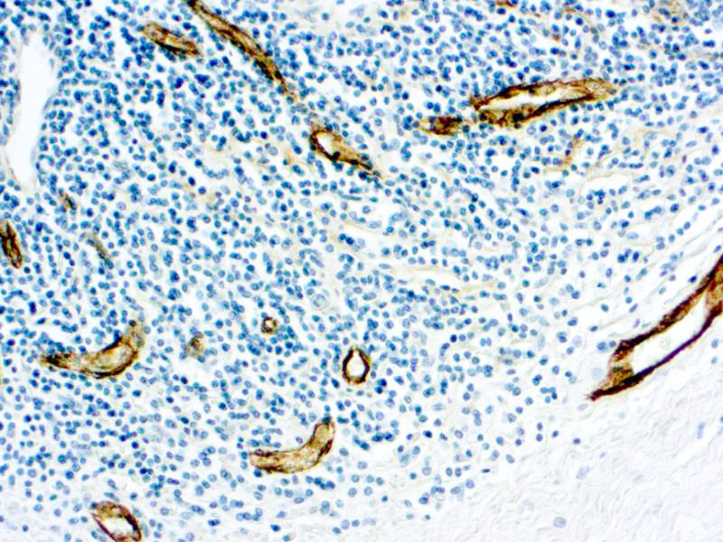 Formalin fixed paraffin embedded human tonsil stained with Factor VIII antibody.