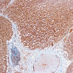 Formalin fixed paraffin embedded human bladder carcinoma stained with Flt-1 antibody.