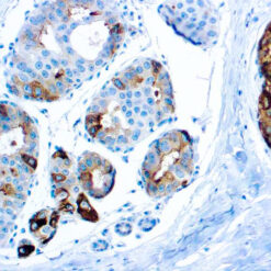 Formalin fixed paraffin embedded human breast carcinoma stained with GCDFP-15.