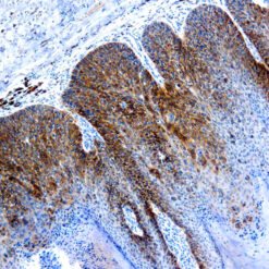 Formalin fixed paraffin embedded cervix Ca stained with HPV-16 antibody.