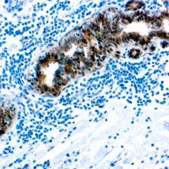 Formalin fixed paraffin embedded human breast carcinoma stained with Heat Shock Protein 70 antibody.