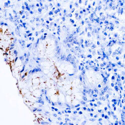 Formalin fixed paraffin embedded human stomach infected with H. pylori and stained with H. pylori antibody.