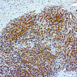 Formalin fixed paraffin embedded human hepatocellular carcinoma stained with Glypican-3.