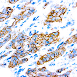 Formalin fixed paraffin embedded human breast carcinoma stained with c-erbB-2 antibody.