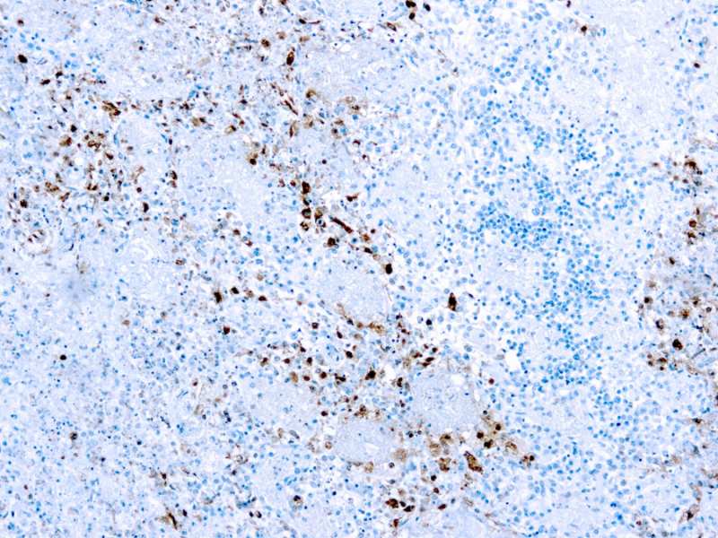 Formalin fixed paraffin embedded Infected tissue stained with HSV I antibody.