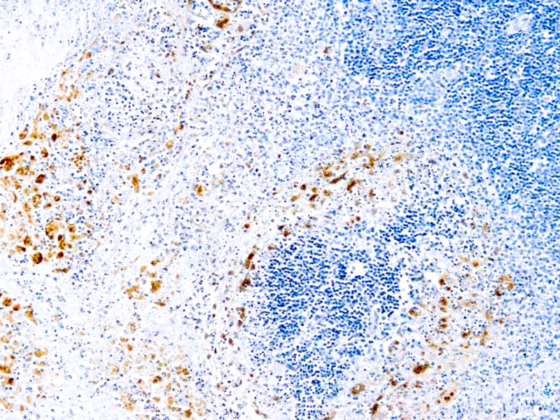 Formalin fixed paraffin embedded human infected tissue stained with Herpes Simplex Visus Type I and Type II antibody.