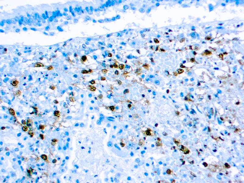 Formalin fixed paraffin embedded human infected tissue stained with Herpes Simplex Visus Type II antibody.