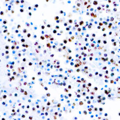 Cultured cells infected with HHV8 stained with HHV8 antibody.