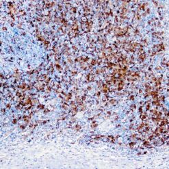 Formalin fixed paraffin embedded human Hodgkin’s lymphoma stained with Fascin-1 antibody.