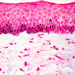 Human Melanoma stained with Fontana Mason Stain (KT014).