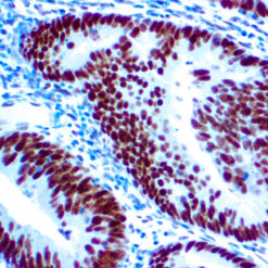 Formalin fixed paraffin embedded human colon carcinoma stained with MLH-1 antibody.