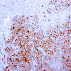 Formalin fixed paraffin embedded human melanoma stained with MART-1 antibody.