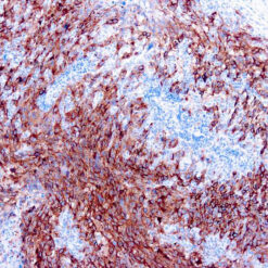 Formalin fixed paraffin embedded human melanoma stained with Melanoma Cocktail.