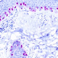 Formalin fixed paraffin embedded human skin stained with MiTF antibody.