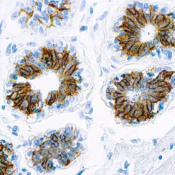 Formalin fixed paraffin embedded human breast carcinoma stained with Epithelial Antigen.